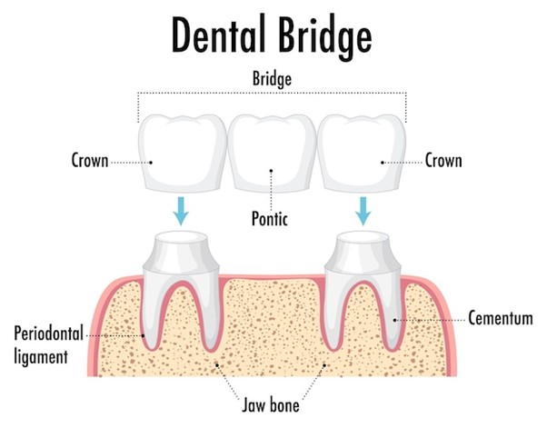 Rediscover Your Perfect Smile with Dental Bridges!